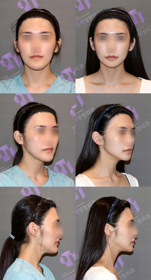 턱끝수술(앞턱수술) 절골법 종류 제대로 파헤치기 관련 이미지 4