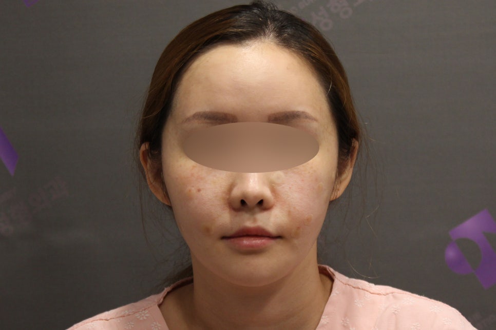 옆광대수술후기, 사례와 함께 알아보기 - 전문의가 직접알려드립니다. 관련 이미지 2