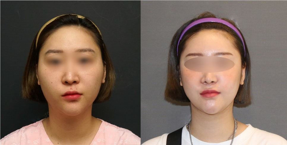 Facial Contouring Swelling, When Can I Go Back to Work? - A Specialist Explains Directly [입체성형외과] image 7