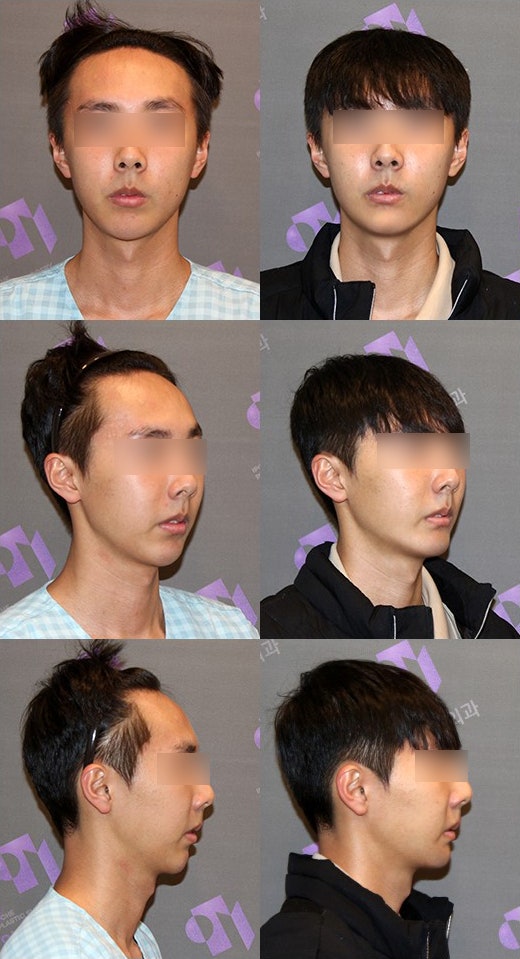 What Surgery Is Needed for a Long, Recessed Chin or a Short, Recessed Chin? image 2