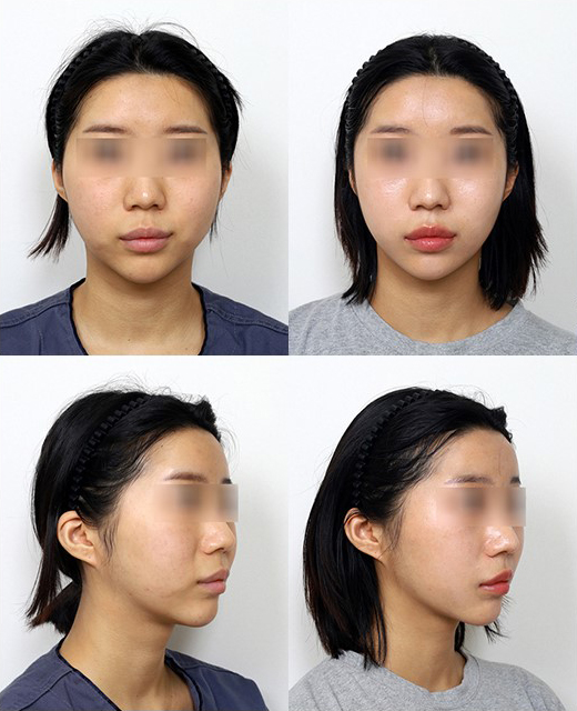 광대뼈 쉐이빙과 얼굴 처짐, 정말 관련이 있을까? 관련 이미지 4