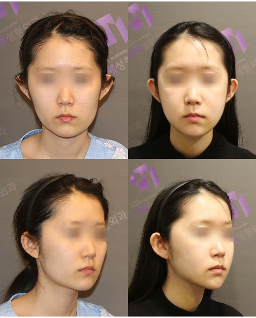 안면윤곽수술로 안면비대칭 교정할 수 있을까요? 관련 이미지 6