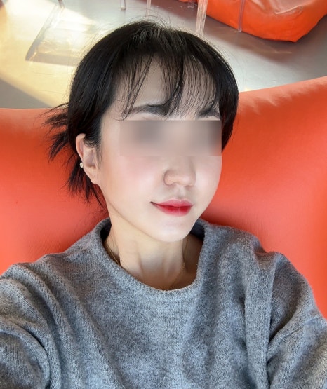 How Long Do Facial Contour Changes Continue After Facial Bone Contouring Surgery? (Day 1 to Day 365) — See With Photos image 7