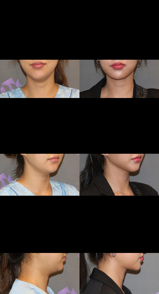 Let's Take a Close Look at Double Chin Removal and Double Chin Muscle Tightening. image 2