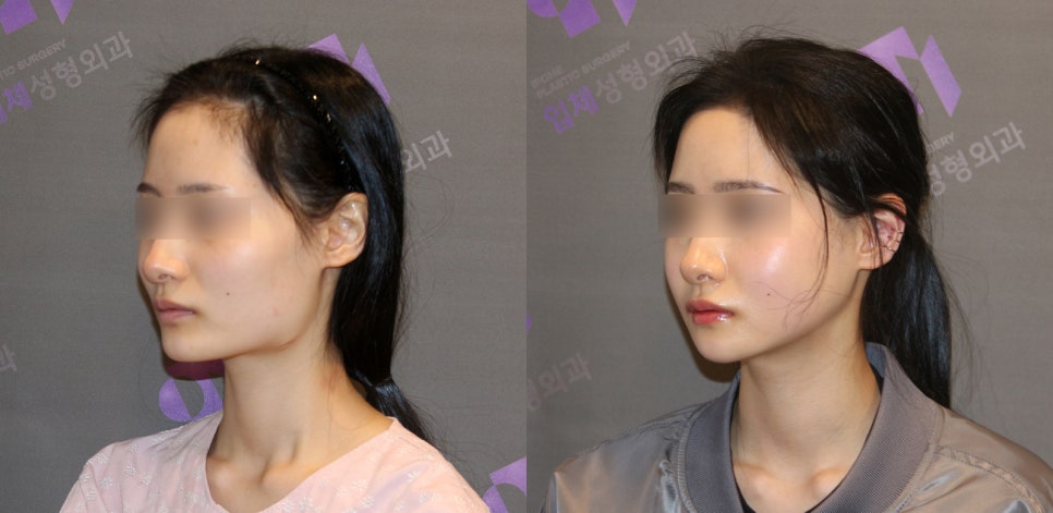 Side Effects of V-Line Square Jaw Surgery, Common Traits of People Who Experience Failed Results image 5