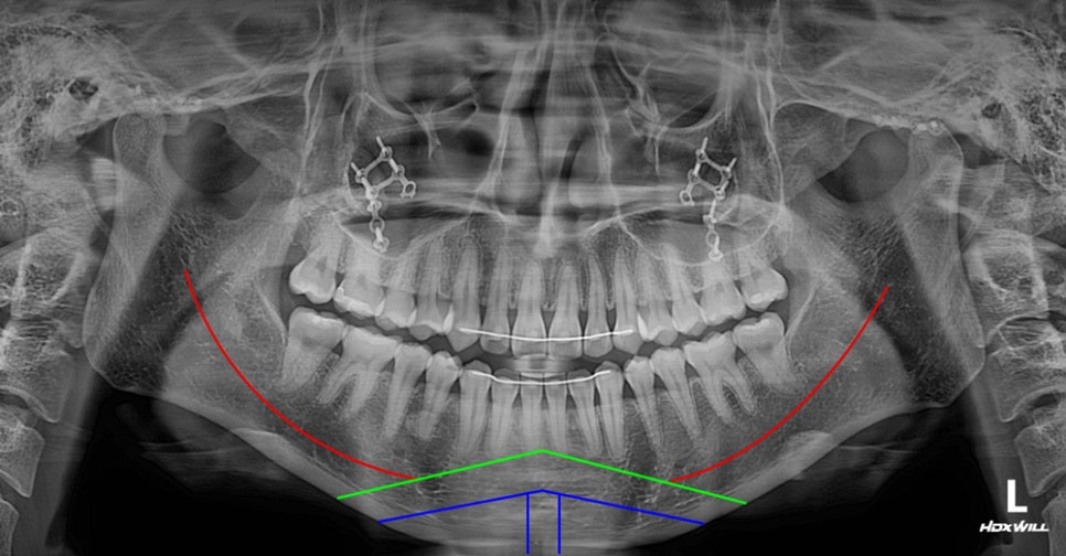 What Side Effects Can Occur Due to Excessive Bone Resection in Facial Contouring Surgery? image 5