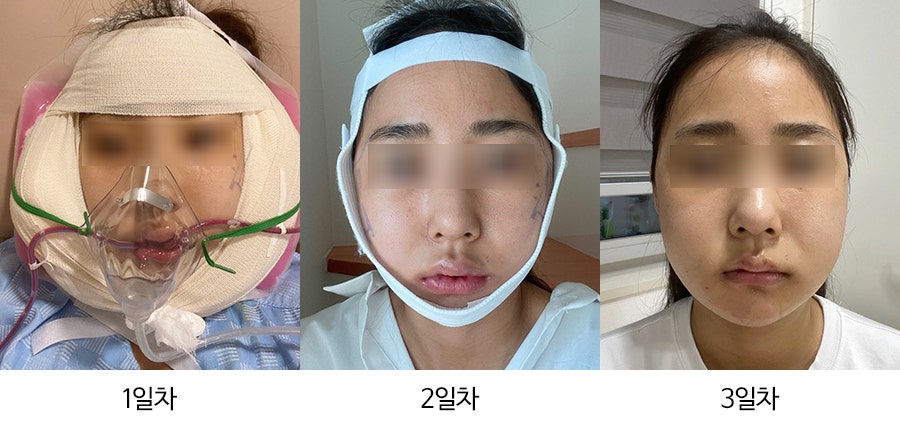 안면윤곽수술 후 붓기, 일차별(1일~30일차)사진과 함께 회복기간 알아보기 관련 이미지 1