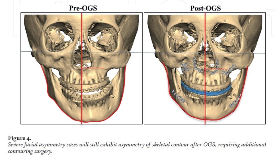 [Paper Review] Technological Advances and Real-World Applications in Modern Facial Contouring Surgery: Correction of Facial Asymmetry image 5