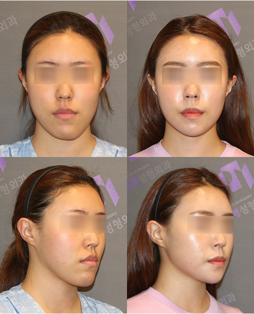 안면윤곽 연예인 고윤정, 카리나 얼굴형처럼 예뻐질 수 있을까요? 관련 이미지 7