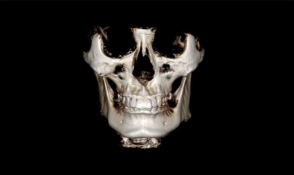 V-Line Square Jaw Surgery Is Good for the Front View Effect image 5