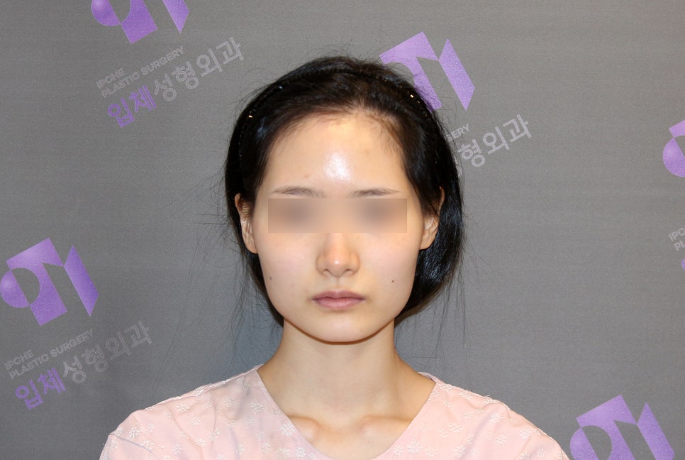 Side Effects of V-Line Square Jaw Surgery, Common Traits of People Who Experience Failed Results image 1