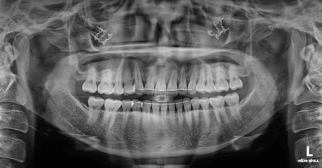Does a Low Nerve Canal Make Square Jaw Surgery Difficult? Ways to Improve Frontal Results image 2
