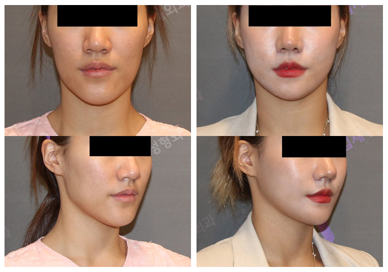 Why Are There So Many Different Chin Surgery Methods? Exploring Advancement, Setback, Reduction, and Lengthening image 4
