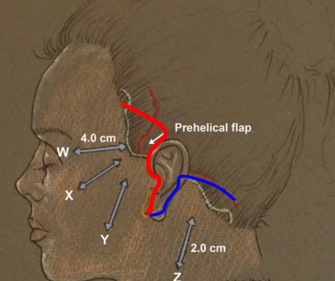 Is it possible to do a mini neck lift on its own? image 2