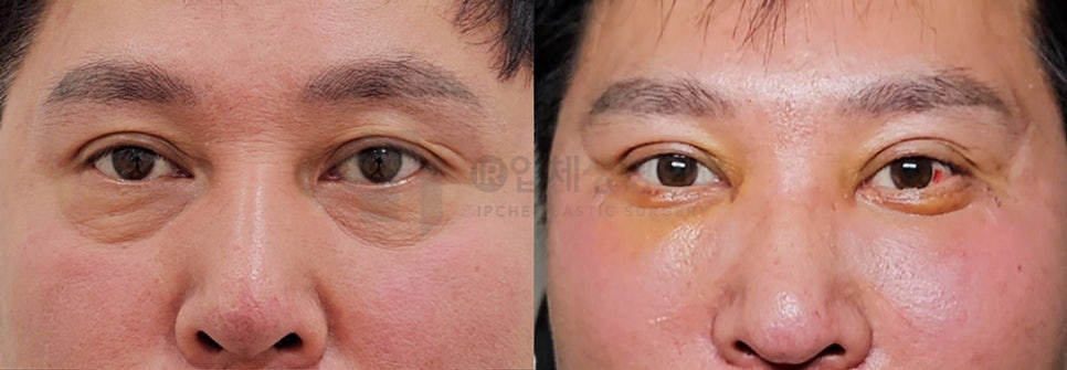How Can a Sunken Midface Be Corrected? image 6