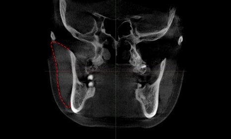 About Masseter Reduction Surgery for Improving the Frontal Effect of the Lower Face image 3