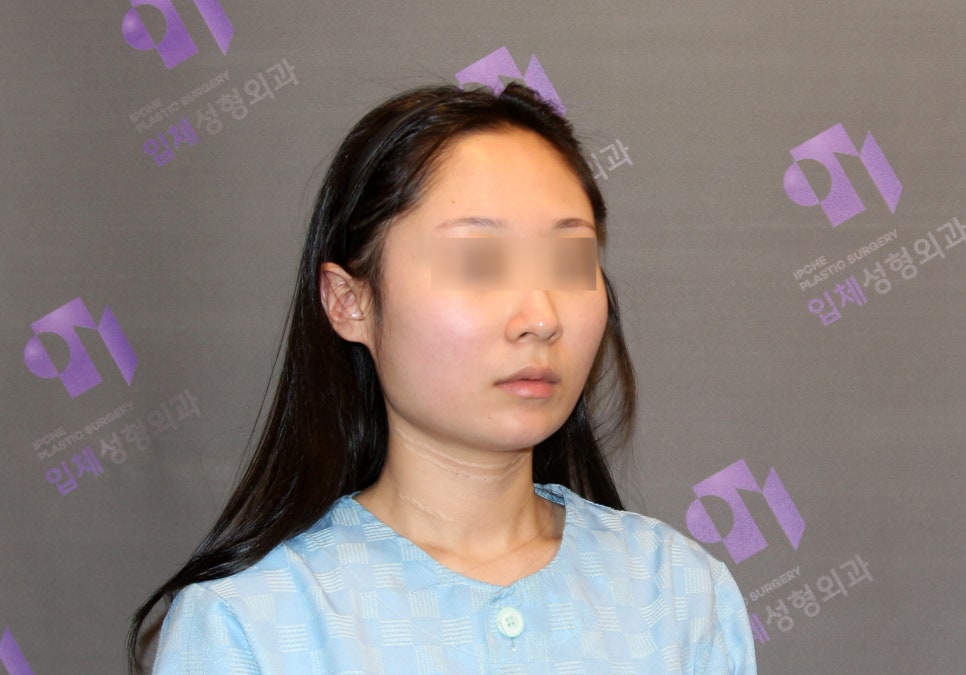 안면윤곽 볼처짐 원인은 무엇인가요? (솔직한 생각) 관련 이미지 3