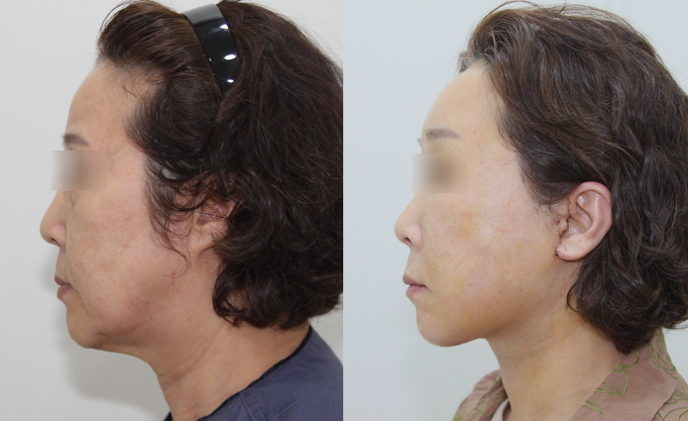 When Are Facial Contouring Surgery and Facelift Surgery Needed Together? image 10