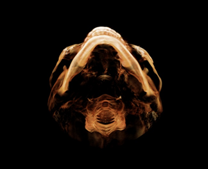 After Facial Contouring Surgery: Asymmetry, When Can Revision Surgery Be Performed? image 6