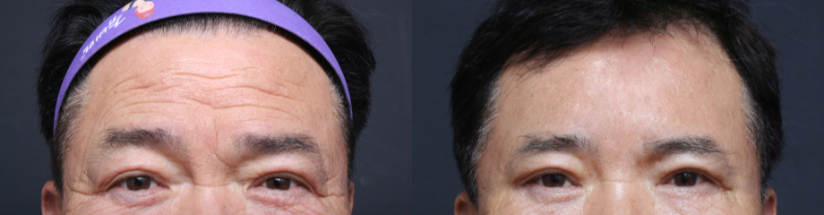 Endoscopic Forehead Lift Swelling and Recovery Time: Looking at It with Before-and-After Photos image 2