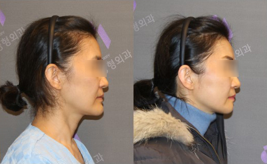 주걱턱 교정은 어떤 수술이 좋을까요? 턱끝후진술의 한계와 실제 결과 관련 이미지 2