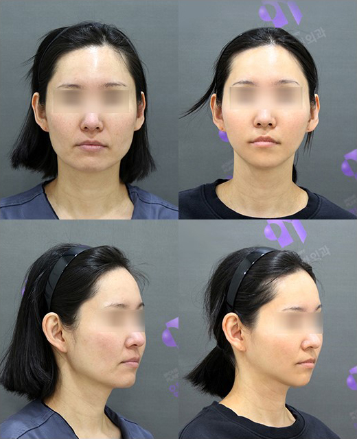 Facial Contouring A to Z: What Is Contouring Surgery? image 6