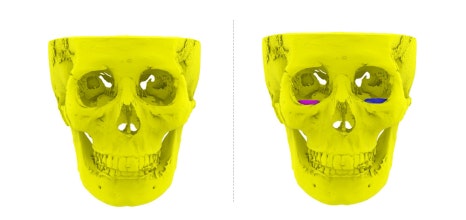 3D프린터 보형물을 이용한 안구함몰, 함몰눈 교정의 실제 사례 관련 이미지 3