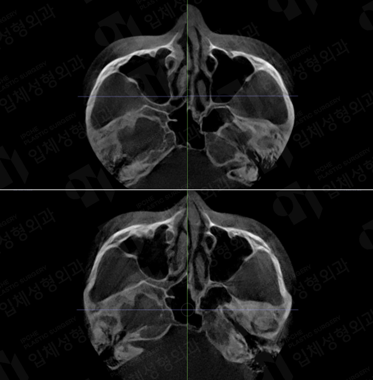Would It Be Better to Use Absorbable Pins in Facial Contouring Surgery? About the Types, Advantages, and Disadvantages of Fixation Pins! image 4