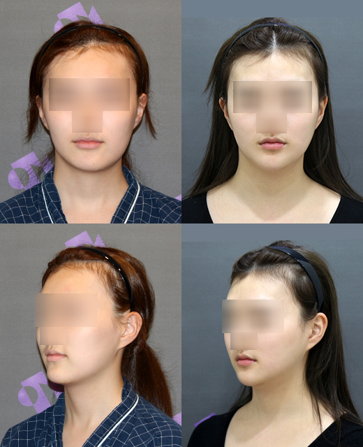 안면윤곽수술, 안면비대칭 교정할 수 있을까요? 관련 이미지 1