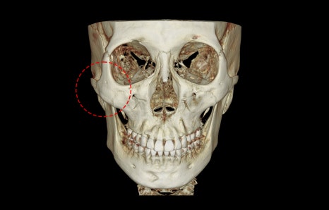 How Much Effect Does 230-Degree Zygoma Reduction Surgery Have? image 3