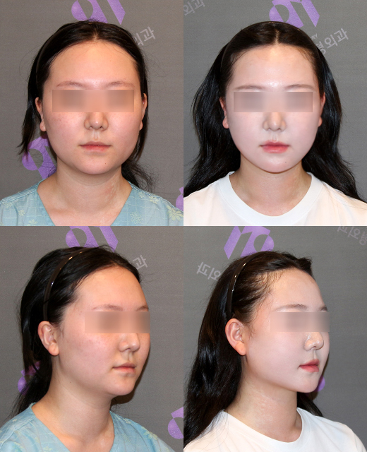 Zygoma Reduction Surgery: the Effectiveness and Selection Criteria of 230-Degree Zygoma vs. 3D Zygoma Surgery image 6