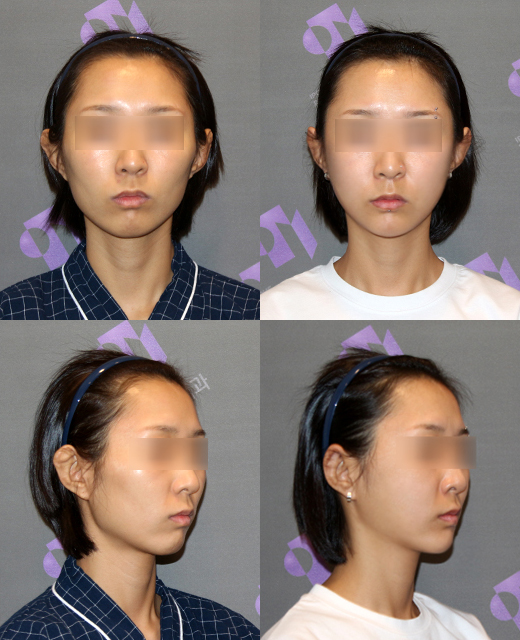 광대수술과 볼패임 교정을 같이 할 수 있나요? 관련 이미지 7