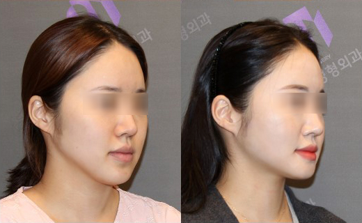 If There Is No Jaw Angle Below the Ear, Is It a Dog Jaw? What Is a Dog Jaw? image 9
