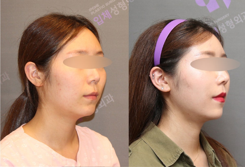 안면윤곽수술비용, 비쌀수록 좋은걸까요? -전문의가 알려드립니다. 관련 이미지 6