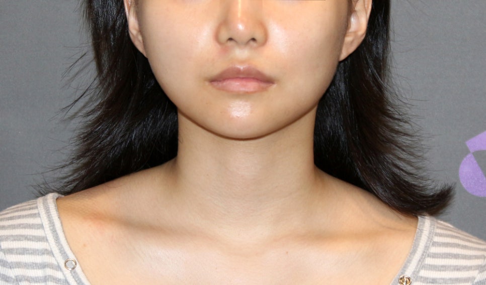 [Chin Surgery] Learning About Contouring Shaving and T-Osteotomy with Real Patient Cases (3) image 15