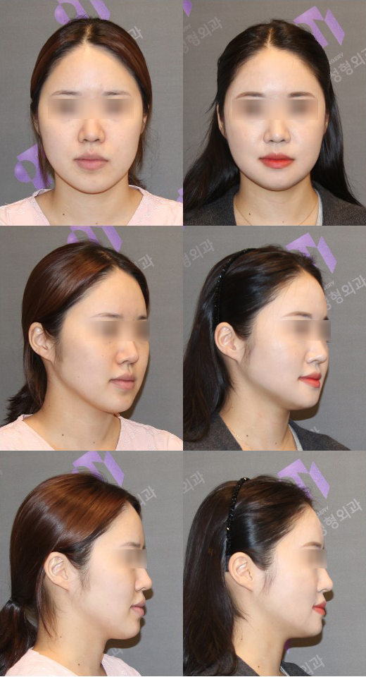 What Side Effects Can Occur After Chin Surgery? image 3