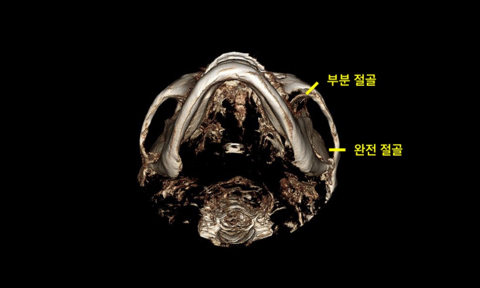 How Much Effect Does 230-Degree Three-Dimensional Zygomatic Reduction Have? image 1