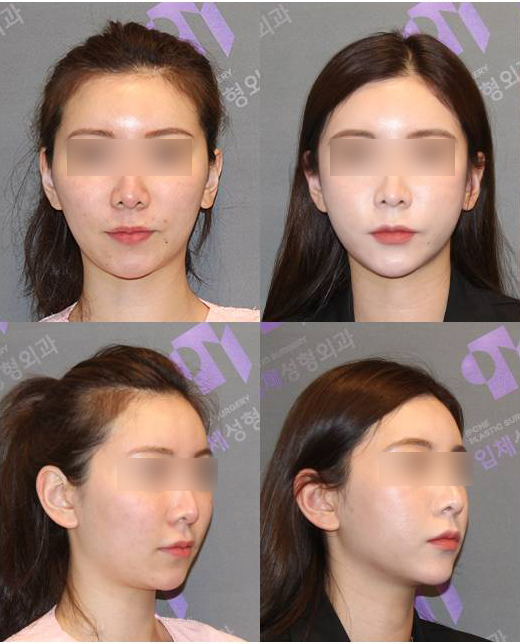 Will cheekbone reduction surgery also make the face smaller? : Learn about how to reduce prominent cheekbones with real surgical cases image 4