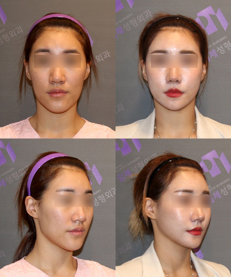 Long Chin, Long Face Contouring - Cases That Do Not Require Double Jaw Surgery image 8