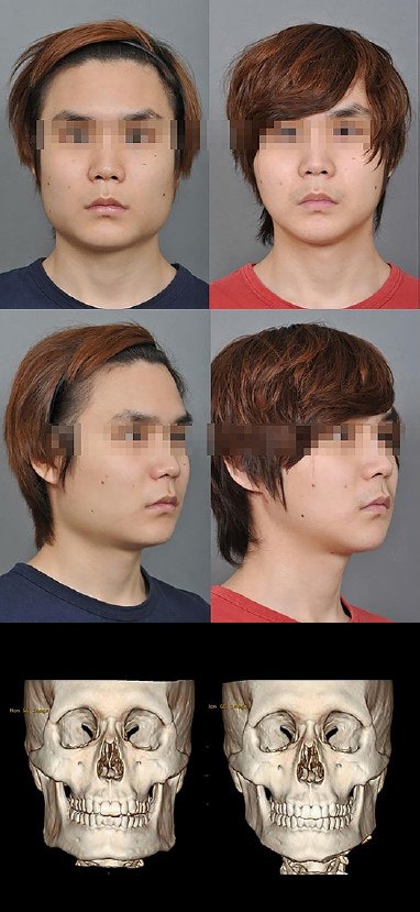 [논문 리뷰] 아시아인 안면윤곽수술에 대해서 관련 이미지 7