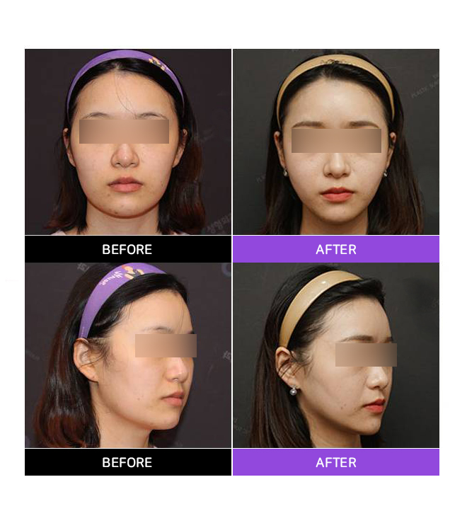 Sunken Cheeks!? It’s Not a Side Effect of Zygoma Surgery! image 6