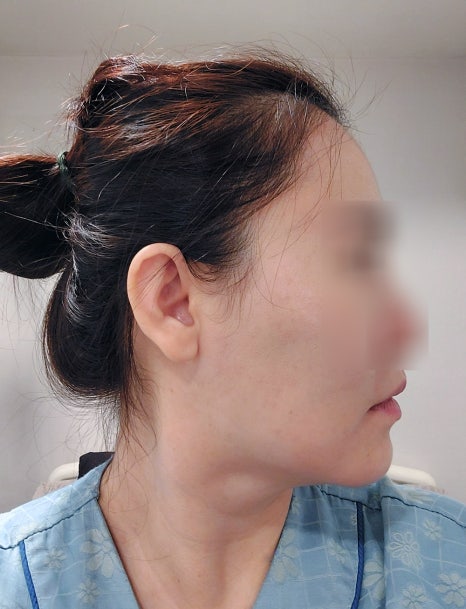사각턱수술 후 사라진 턱선은 어떻게 해야할까요? (feat.엘라스티꿈 목리프팅) 관련 이미지 2
