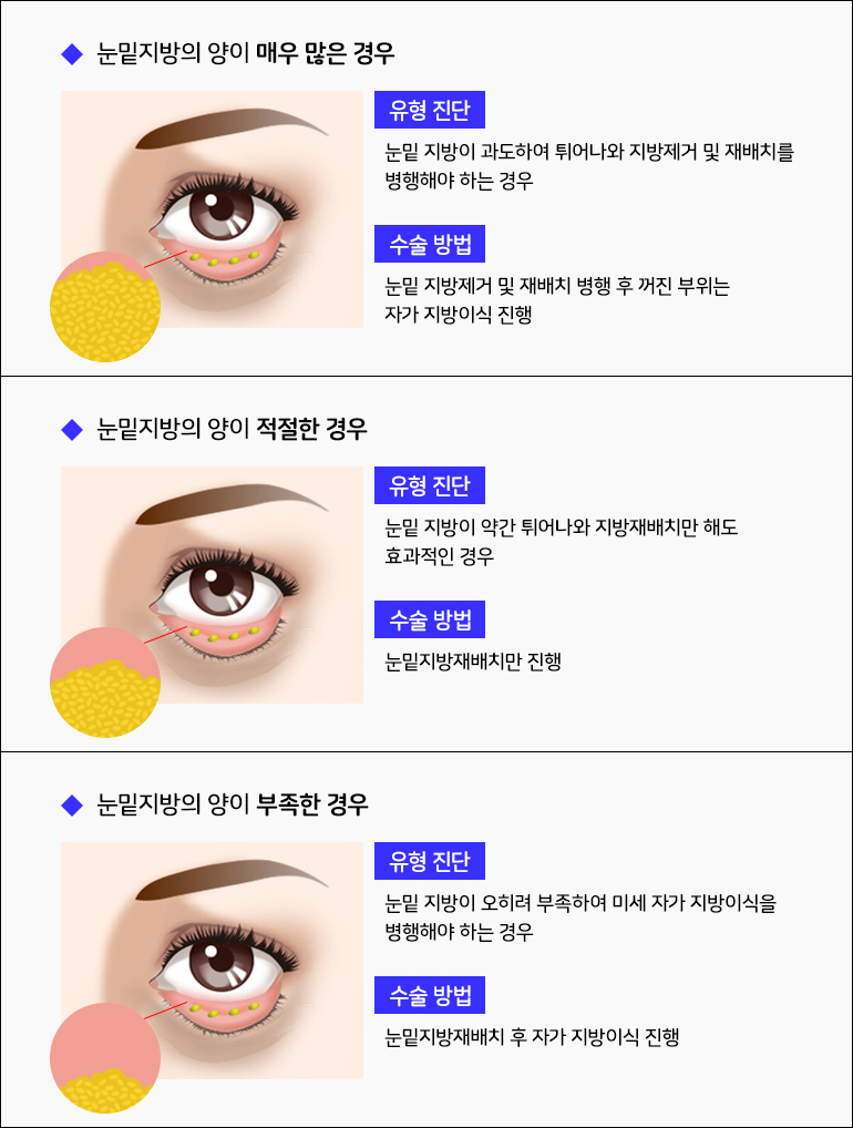 눈밑지방재배치와 하안검 수술이 어떻게 다른가요? 관련 이미지 6