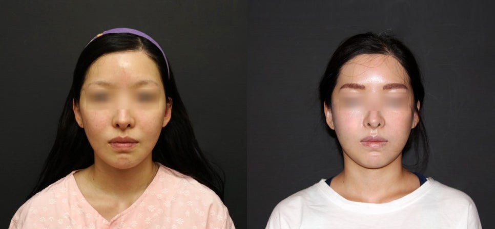 230도 입체 광대축소술로 재수술도 가능할까요? 관련 이미지 5