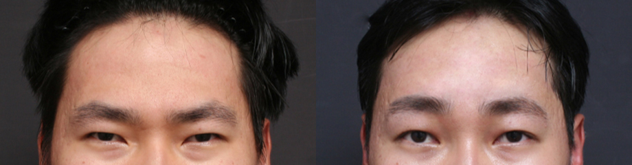 Endoscopic Forehead Lift Swelling and Recovery Time: Looking at It with Before-and-After Photos image 4