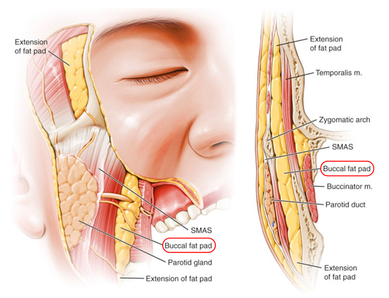 If you’re worried about jowls (bulldog cheeks) but were recommended buccal fat removal, what should you do? image 2