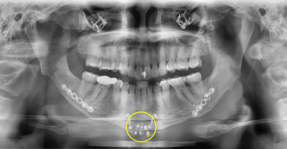 What Side Effects Can Occur Due to Excessive Bone Resection in Facial Contouring Surgery? image 6