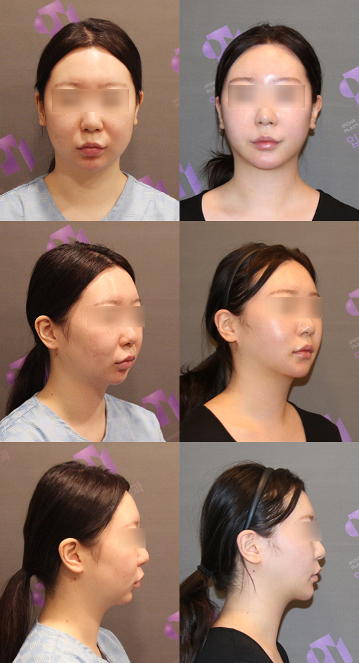 Chin Implants and Chin Advancement Surgery: Real Surgical Cases and What to Know image 3