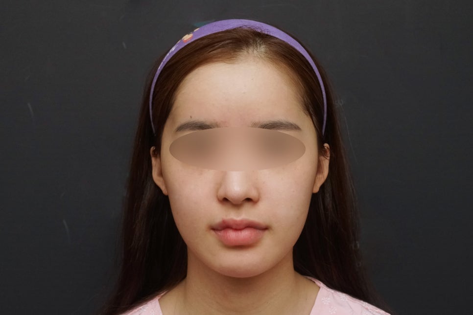 안면윤곽연예인, 연예인들은 왜 갈수록 예뻐질까요? - 성형외과 전문의가 직접알려드립니다. 관련 이미지 7
