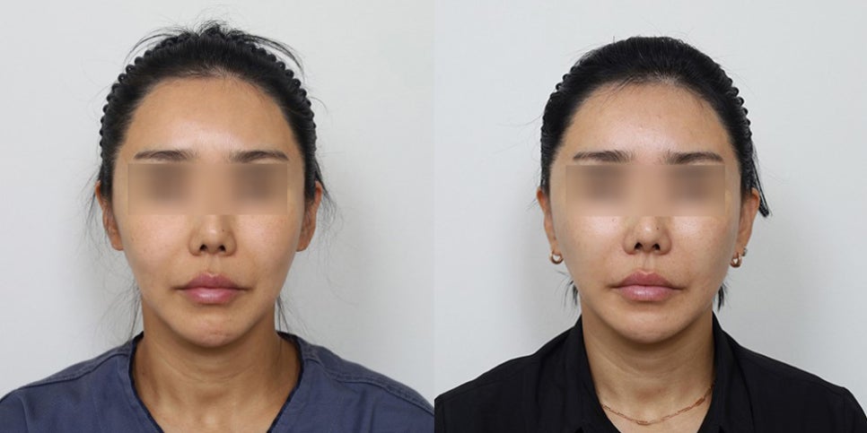 실리프팅을 여러 번 하면, 왜 안면거상 수술이 어려워질까? 관련 이미지 4